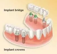Dental implant bridge and individual implant crowns