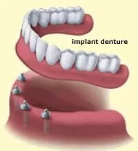 Dental implant denture