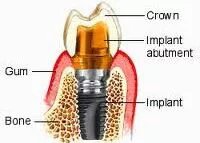 Dental implant, abutment and crown illustration